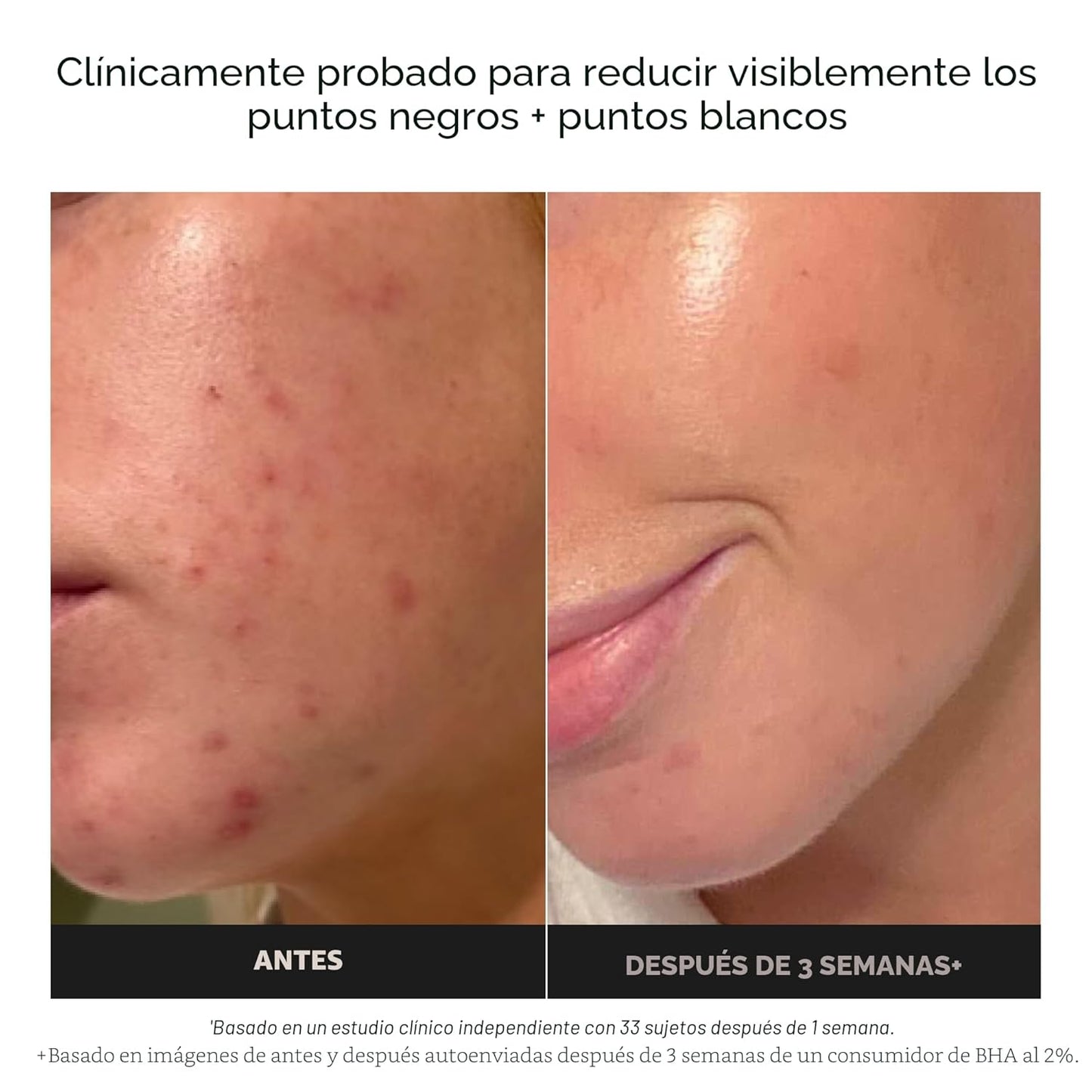 EXFOLIATE- Exfoliante Facial con Acido Salicílico