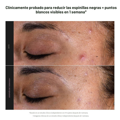 EXFOLIATE- Exfoliante Facial con Acido Salicílico